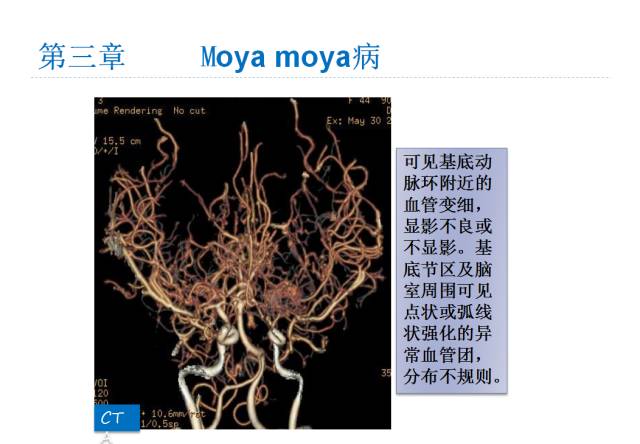 【PPT】颅脑血管性疾病影像学