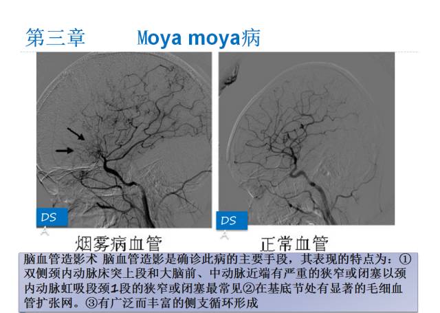 【PPT】颅脑血管性疾病影像学