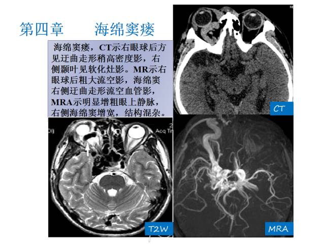 【PPT】颅脑血管性疾病影像学
