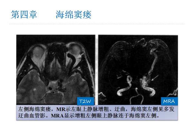 【PPT】颅脑血管性疾病影像学