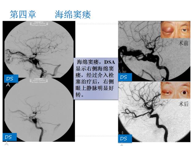 【PPT】颅脑血管性疾病影像学