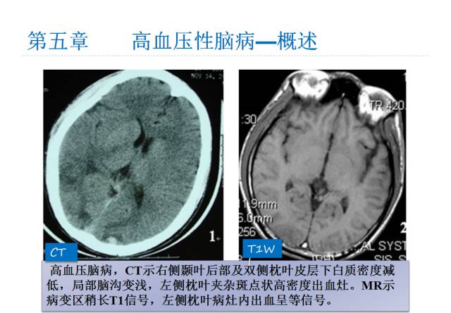 【PPT】颅脑血管性疾病影像学