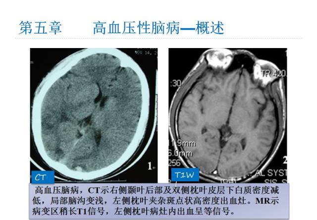 【PPT】颅脑血管性疾病影像学