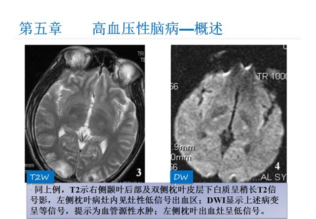 【PPT】颅脑血管性疾病影像学