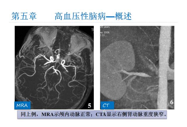 【PPT】颅脑血管性疾病影像学