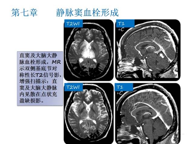 【PPT】颅脑血管性疾病影像学