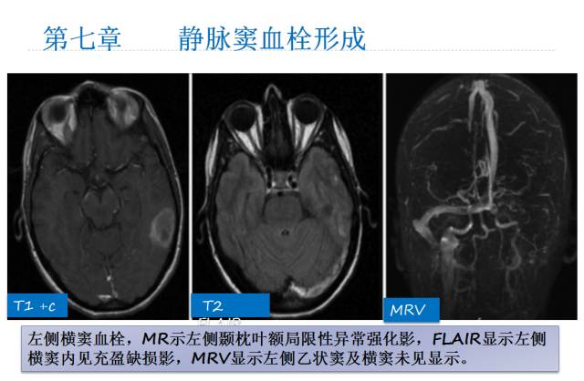 【PPT】颅脑血管性疾病影像学