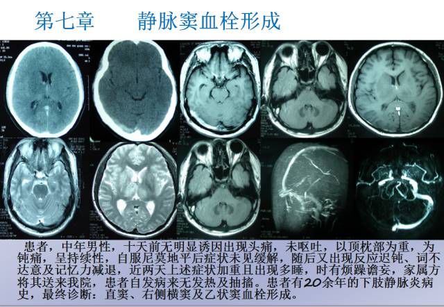 【PPT】颅脑血管性疾病影像学
