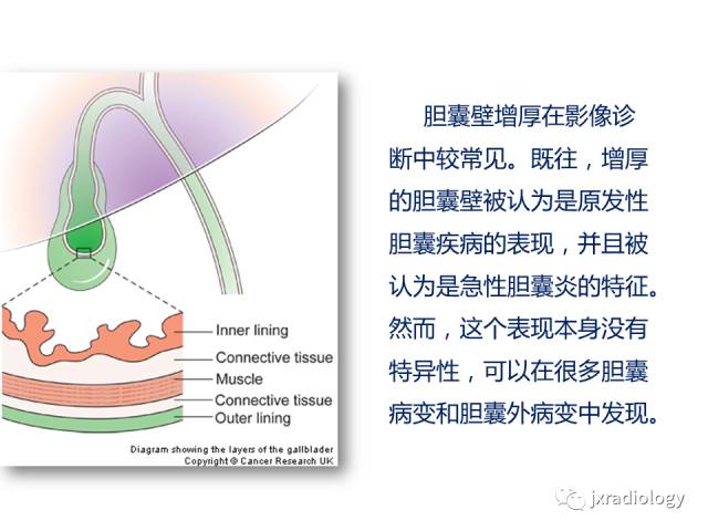 【PPT】弥漫性胆囊壁增厚的影像鉴别诊断