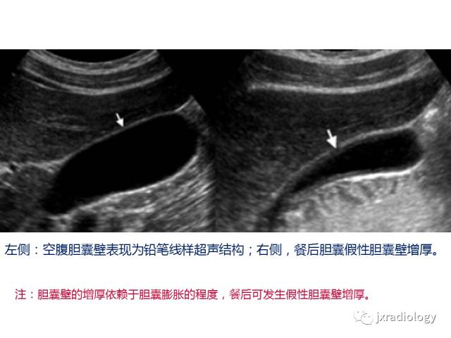 【PPT】弥漫性胆囊壁增厚的影像鉴别诊断