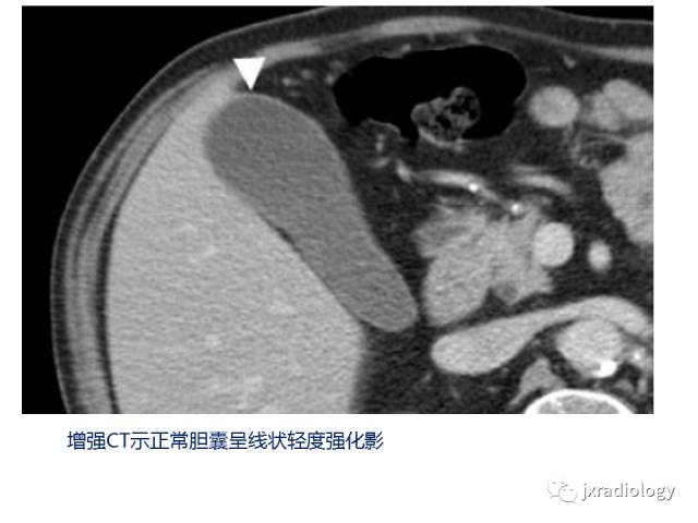 【PPT】弥漫性胆囊壁增厚的影像鉴别诊断