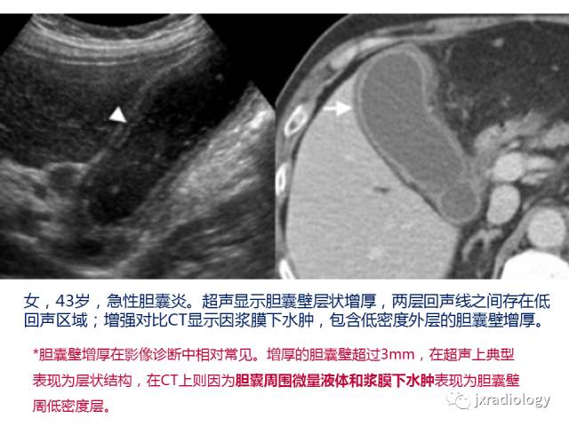 【PPT】弥漫性胆囊壁增厚的影像鉴别诊断