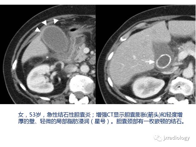 【PPT】弥漫性胆囊壁增厚的影像鉴别诊断