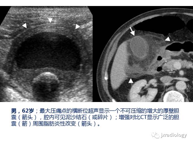 【PPT】弥漫性胆囊壁增厚的影像鉴别诊断