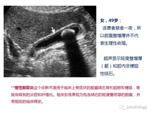 【PPT】弥漫性胆囊壁增厚的影像鉴别诊断