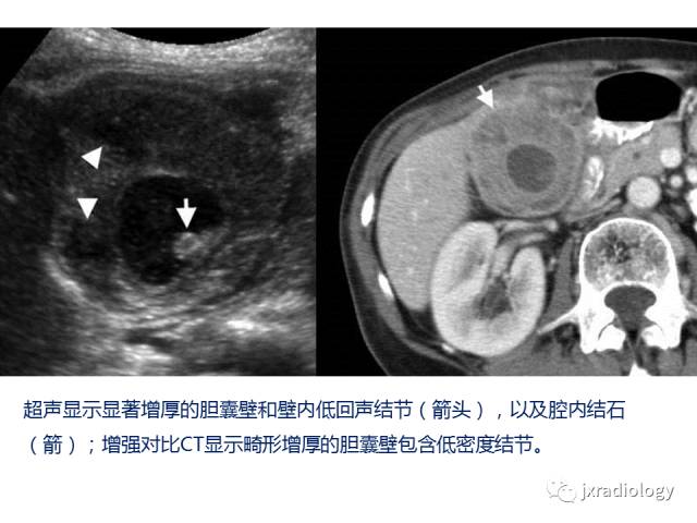【PPT】弥漫性胆囊壁增厚的影像鉴别诊断
