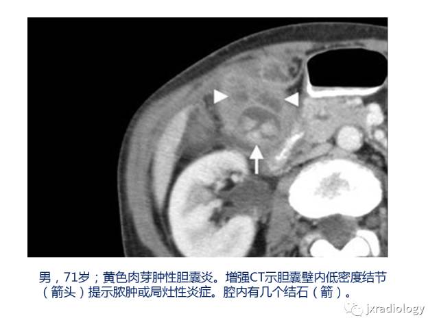 【PPT】弥漫性胆囊壁增厚的影像鉴别诊断