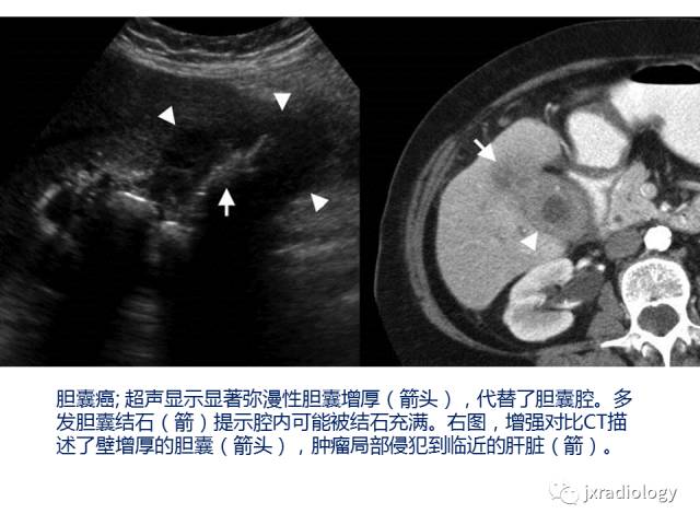 【PPT】弥漫性胆囊壁增厚的影像鉴别诊断