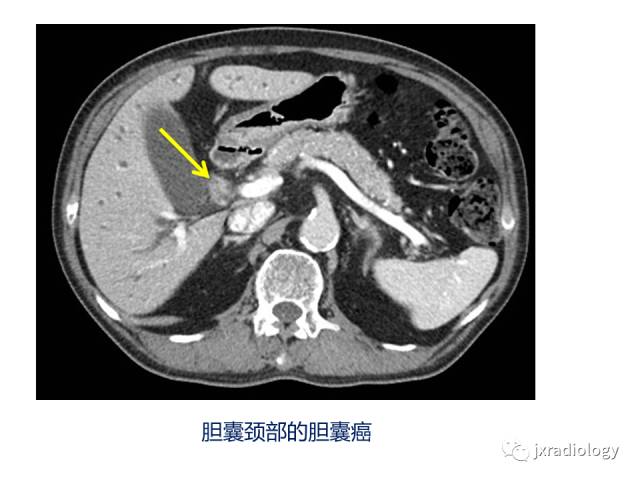 【PPT】弥漫性胆囊壁增厚的影像鉴别诊断
