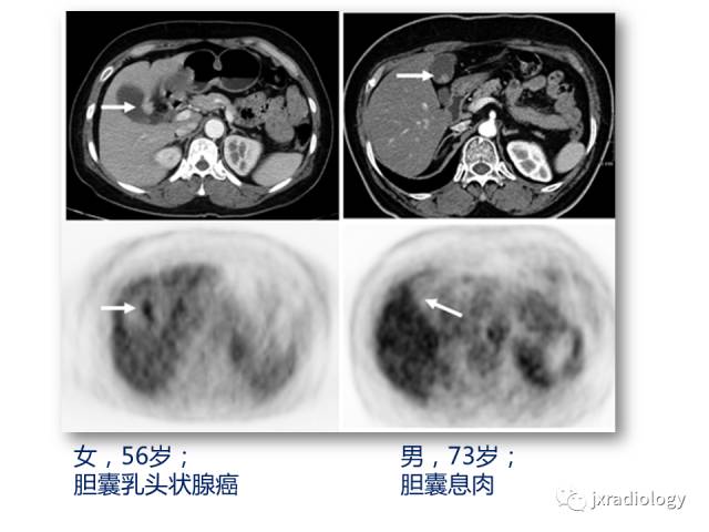 【PPT】弥漫性胆囊壁增厚的影像鉴别诊断