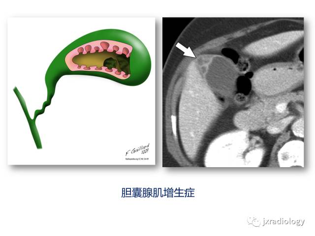 【PPT】弥漫性胆囊壁增厚的影像鉴别诊断