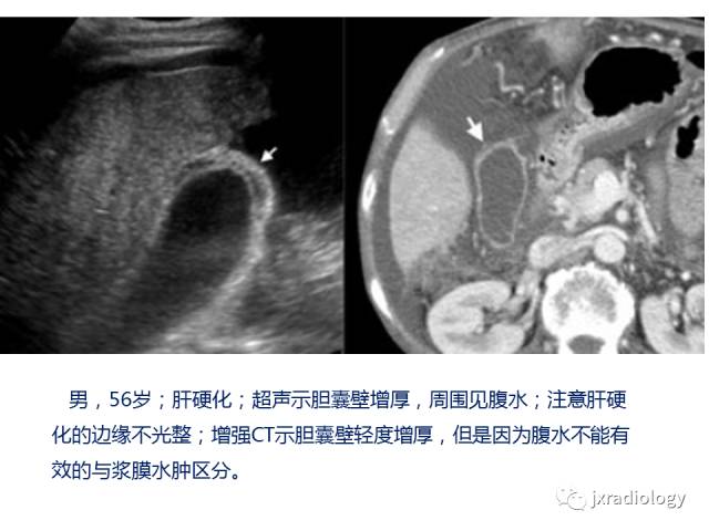 【PPT】弥漫性胆囊壁增厚的影像鉴别诊断