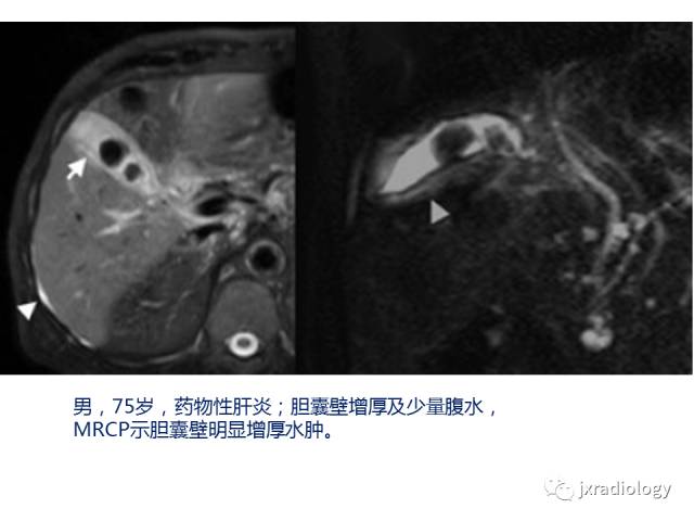 【PPT】弥漫性胆囊壁增厚的影像鉴别诊断