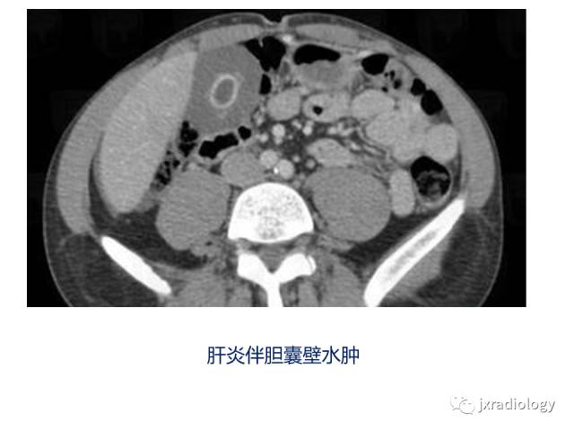 【PPT】弥漫性胆囊壁增厚的影像鉴别诊断
