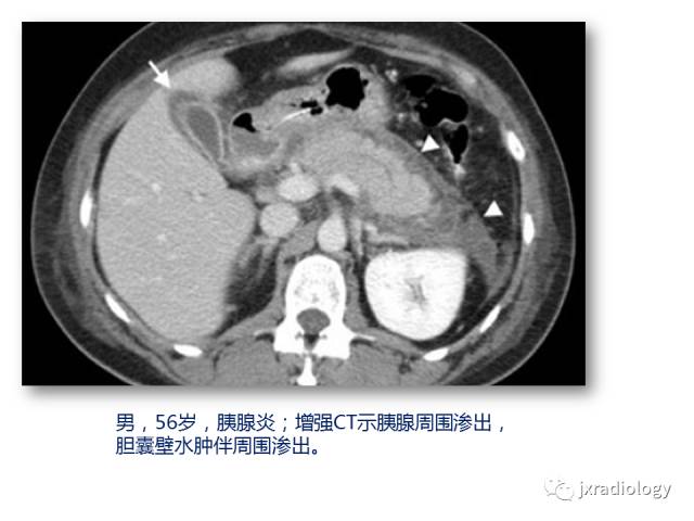 【PPT】弥漫性胆囊壁增厚的影像鉴别诊断