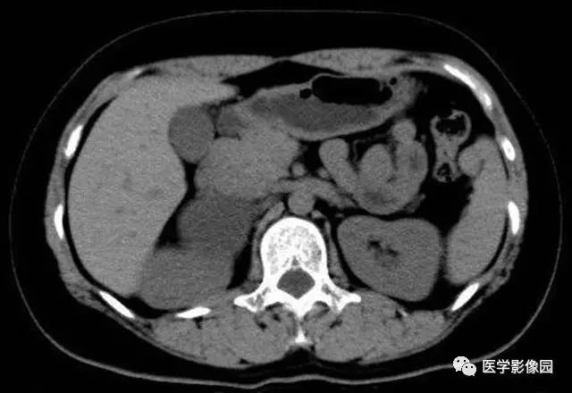 【病例】肾上腺表皮样囊肿1例CT影像表现 【病例】肾上腺表皮样囊肿1例CT影像表现