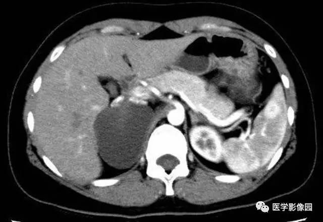 【病例】肾上腺表皮样囊肿1例CT影像表现 【病例】肾上腺表皮样囊肿1例CT影像表现
