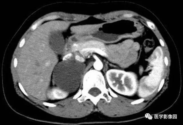 【病例】肾上腺表皮样囊肿1例CT影像表现 【病例】肾上腺表皮样囊肿1例CT影像表现