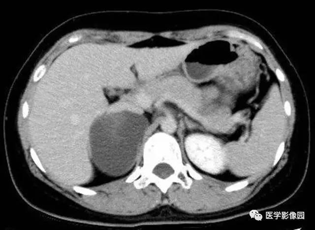 【病例】肾上腺表皮样囊肿1例CT影像表现 【病例】肾上腺表皮样囊肿1例CT影像表现