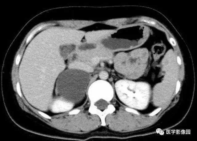 【病例】肾上腺表皮样囊肿1例CT影像表现 【病例】肾上腺表皮样囊肿1例CT影像表现