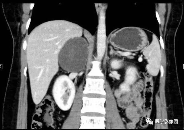 【病例】肾上腺表皮样囊肿1例CT影像表现 【病例】肾上腺表皮样囊肿1例CT影像表现
