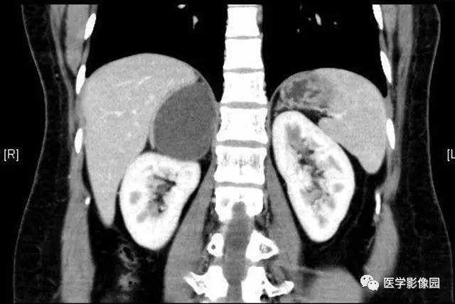 【病例】肾上腺表皮样囊肿1例CT影像表现 【病例】肾上腺表皮样囊肿1例CT影像表现
