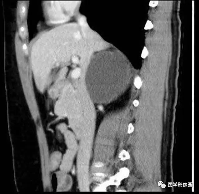 【病例】肾上腺表皮样囊肿1例CT影像表现 【病例】肾上腺表皮样囊肿1例CT影像表现