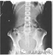 【病例】两侧髓质海绵肾1例CT 【病例】两侧髓质海绵肾1例CT