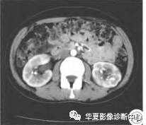 【病例】两侧髓质海绵肾1例CT 【病例】两侧髓质海绵肾1例CT