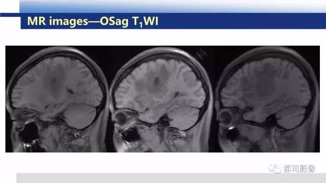 【PPT】原发性中枢神经系统淋巴瘤影像诊断