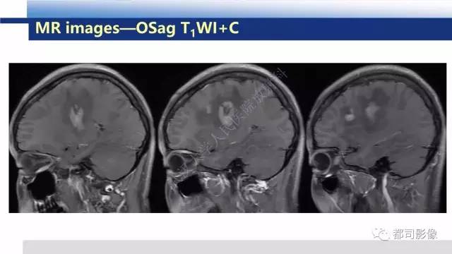 【PPT】原发性中枢神经系统淋巴瘤影像诊断