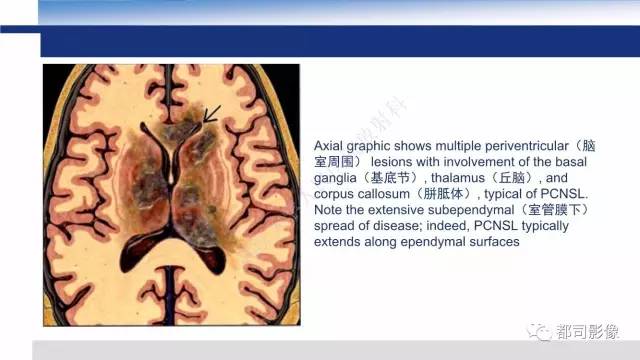 【PPT】原发性中枢神经系统淋巴瘤影像诊断