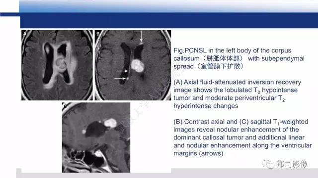 【PPT】原发性中枢神经系统淋巴瘤影像诊断