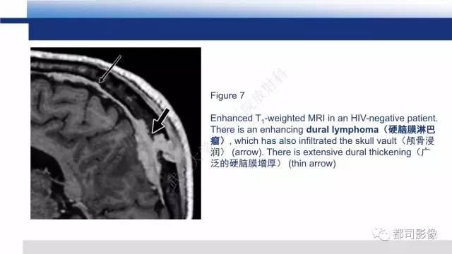 【PPT】原发性中枢神经系统淋巴瘤影像诊断