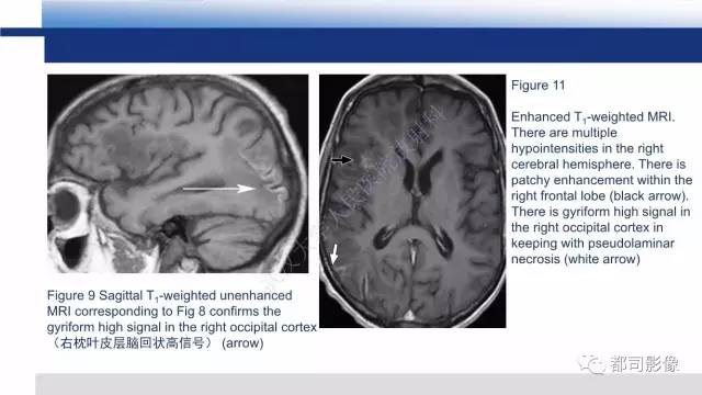 【PPT】原发性中枢神经系统淋巴瘤影像诊断