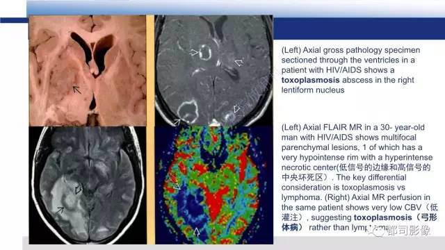 【PPT】原发性中枢神经系统淋巴瘤影像诊断