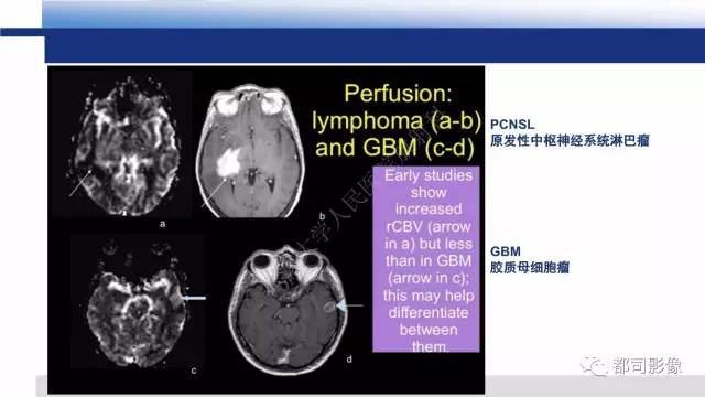 【PPT】原发性中枢神经系统淋巴瘤影像诊断