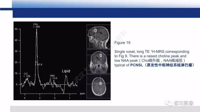 【PPT】原发性中枢神经系统淋巴瘤影像诊断