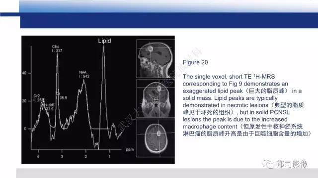 【PPT】原发性中枢神经系统淋巴瘤影像诊断
