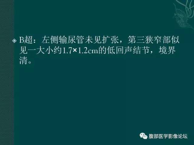 【病例】左输尿管下段区副神经节瘤1例CT影像表现